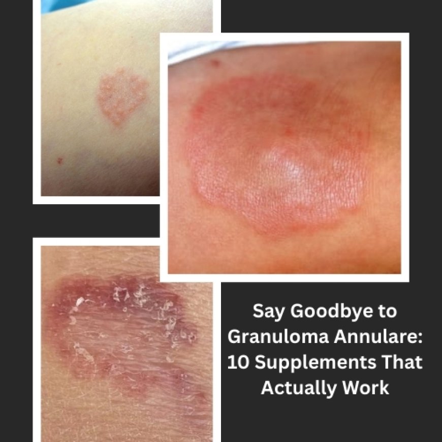 Say Goodbye to Granuloma Annulare: 10 Supplements That Actually Work